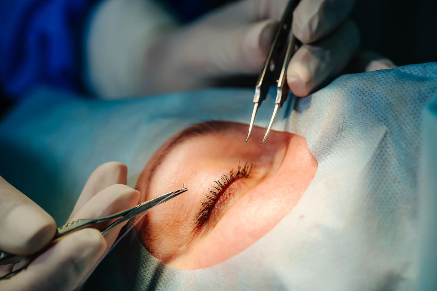 Cirurgia para correção de grau